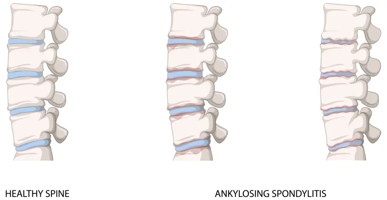 후종인대 골화증 Ossification of Posterior Longitudinal Ligament